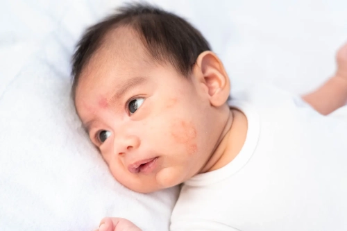 Kenali Macam Macam Alergi Kulit Pada Bayi