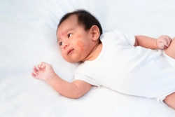 Muncul Bintik Merah di Kulit Bayi, Bagaimana Cara Mengatasinya?