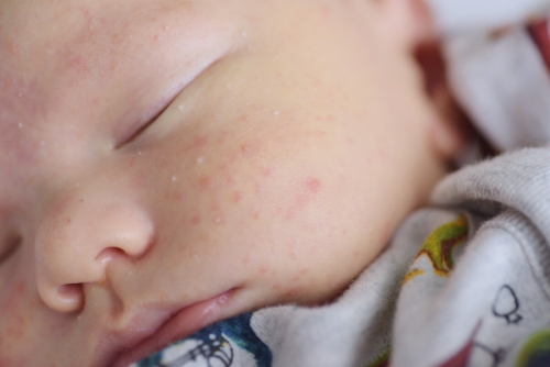 Moms Wajib Tahu! Perawatan Kulit Bayi untuk Mengurangi Biang Keringat