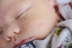 Moms Wajib Tahu! Perawatan Kulit Bayi untuk Mengurangi Biang Keringat