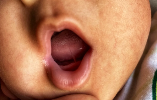 Pengaruh Lip Tie dan Tongue Tie (Ankyloglossia) Terhadap Kenaikan Berat Badan Bayi