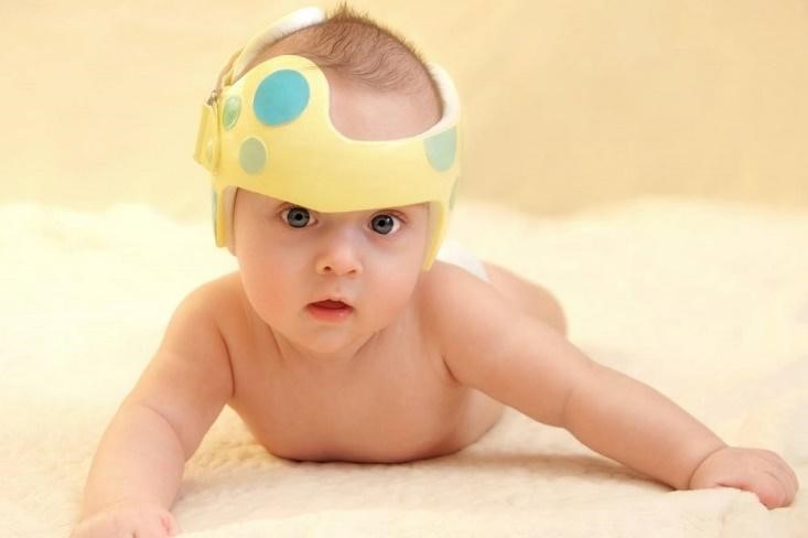 Helm Terapi, Fungsi dan Cara Pemakaiannya yang Tepat untuk Si Kecil yang Masih Bayi
