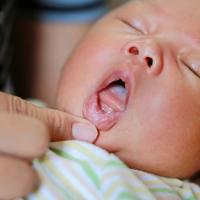 Tips Mengatasi Sariawan pada Bayi agar Si Kecil Tak Rewel Lagi