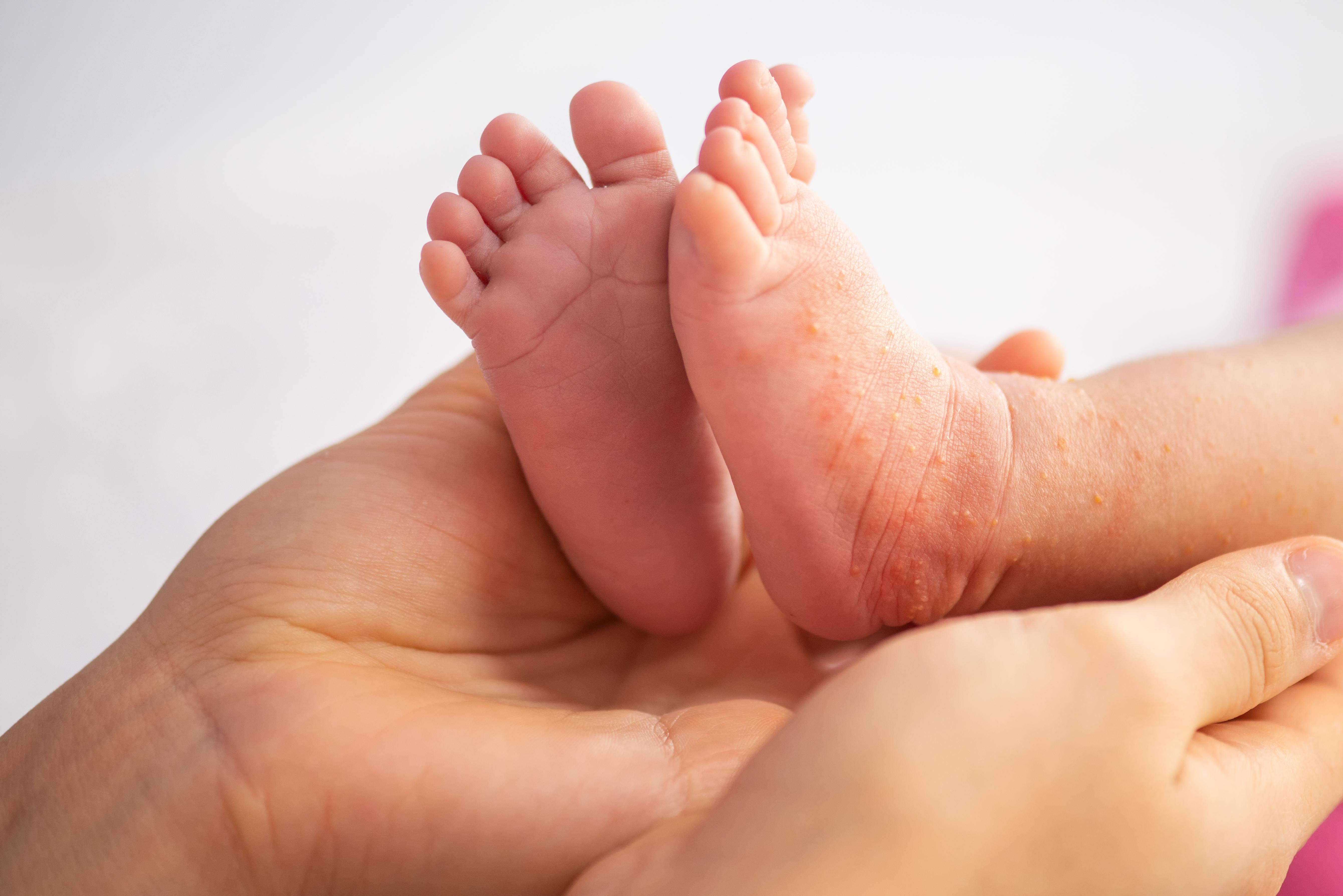 Penyebab dan Cara Mengatasi Iritasi Kulit Bayi